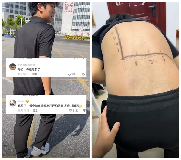 男生拍抽象视频被网友诊断为脊柱隐裂：神了