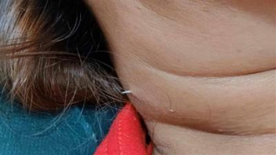 泰国女子吃鱼时被鱼刺扎穿脖子：医生直呼活久见-萌图百科