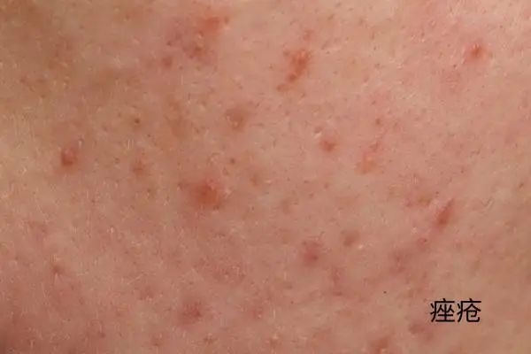 几块钱一管的维A酸乳膏：是护肤圣品 还是致癌毒物