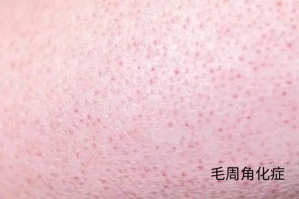 几块钱一管的维A酸乳膏：是护肤圣品 还是致癌毒物
