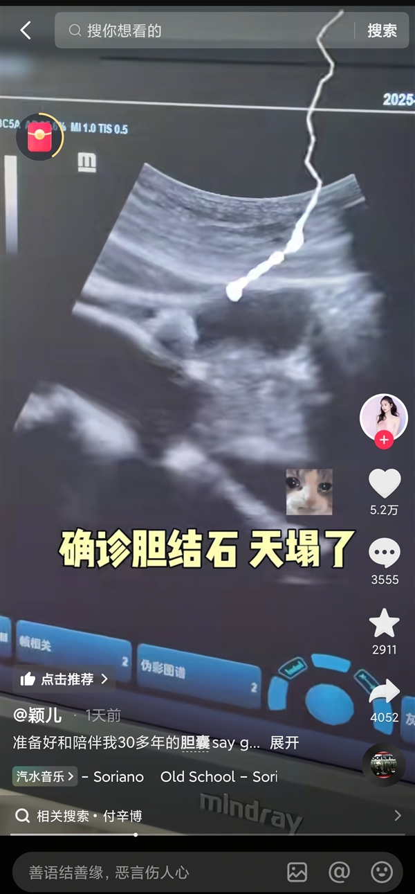 女演员颖儿因腹部剧痛切除胆囊：确诊胆结石 天塌了