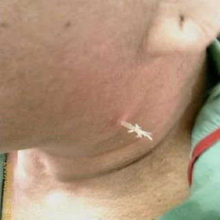 女子被鱼刺卡喉2周 2次就医均没发现 最终鱼刺从脖子穿出