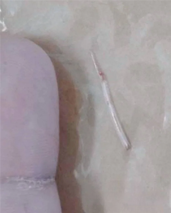 女子被鱼刺卡喉2周 2次就医均没发现 最终鱼刺从脖子穿出