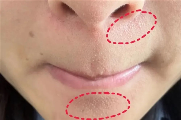 真的想问：下巴凸起的小颗粒 到底是什么呀！-萌图百科