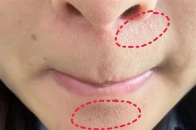 真的想问：下巴凸起的小颗粒 到底是什么呀！-萌图百科