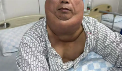 男子每天1斤酒喝出“河马颈” 医生：长期饮酒警惕脂肪异常堆积-萌图百科